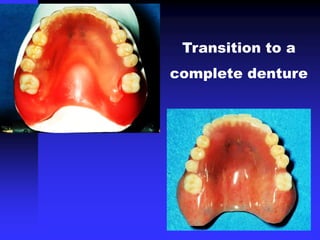 Transition to a
complete denture
 