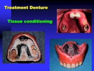 Tissue conditioning
Treatment Denture
 