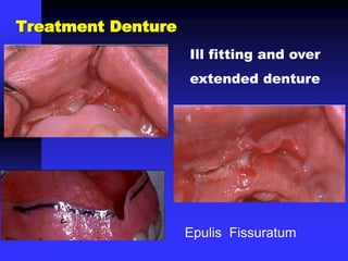 Epulis Fissuratum
Ill fitting and over
extended denture
Treatment Denture
 