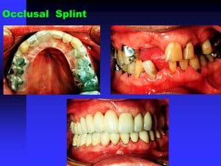 Occlusal Splint
 