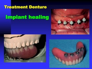 Implant healing
Treatment Denture
 