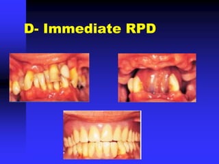 D- Immediate RPD
 