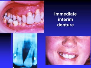 Immediate
interim
denture
 