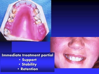 Immediate treatment partial
• Support
• Stability
• Retention
 