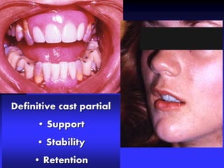 Definitive cast partial
• Support
• Stability
• Retention
 