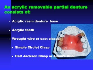 An acrylic removable partial denture
consists of:
 Acrylic resin denture base
 Acrylic teeth
 Wrought wire or cast clasps:
 Simple Circlet Clasp
 Half Jackson Clasp or Adam’s Crib:
 