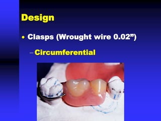 Design
 Clasps (Wrought wire 0.02”)
 Circumferential
 