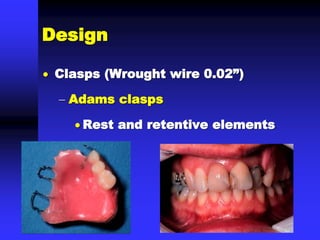  Clasps (Wrought wire 0.02”)
 Adams clasps
 Rest and retentive elements
Design
 
