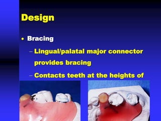  Bracing
 Lingual/palatal major connector
provides bracing
 Contacts teeth at the heights of
contour
Design
 