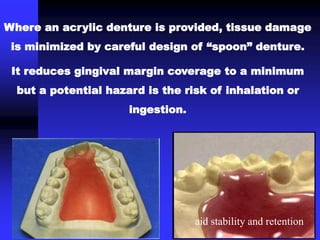 Where an acrylic denture is provided, tissue damage
is minimized by careful design of “spoon” denture.
It reduces gingival margin coverage to a minimum
but a potential hazard is the risk of inhalation or
ingestion.
aid stability and retention
 