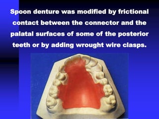 Spoon denture was modified by frictional
contact between the connector and the
palatal surfaces of some of the posterior
teeth or by adding wrought wire clasps.
 