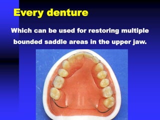 Which can be used for restoring multiple
bounded saddle areas in the upper jaw.
Every denture
 