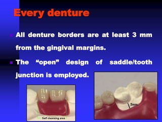  All denture borders are at least 3 mm
from the gingival margins.
 The “open” design of saddle/tooth
junction is employed.
Every denture
 