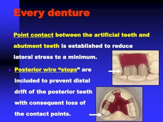  Point contact between the artificial teeth and
abutment teeth is established to reduce
lateral stress to a minimum.
Every denture
 Posterior wire “stops” are
included to prevent distal
drift of the posterior teeth
with consequent loss of
the contact points.
 