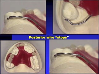 Posterior wire “stops”
 