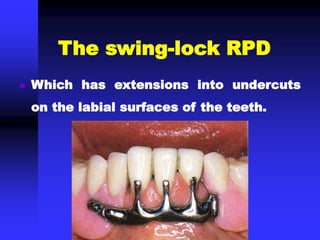  Which has extensions into undercuts
on the labial surfaces of the teeth.
The swing-lock RPD
 