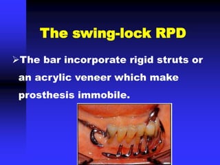 The bar incorporate rigid struts or
an acrylic veneer which make
prosthesis immobile.
The swing-lock RPD
 