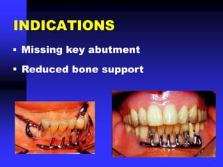 INDICATIONS
 Missing key abutment
 Reduced bone support
 