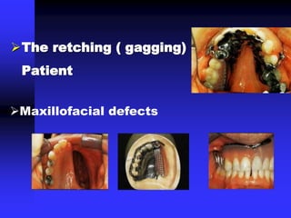 The retching ( gagging)
Patient
Maxillofacial defects
 