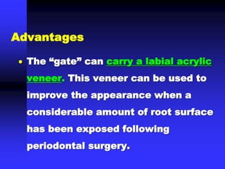  The “gate” can carry a labial acrylic
veneer. This veneer can be used to
improve the appearance when a
considerable amount of root surface
has been exposed following
periodontal surgery.
Advantages
 