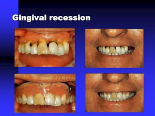 Gingival recession
 