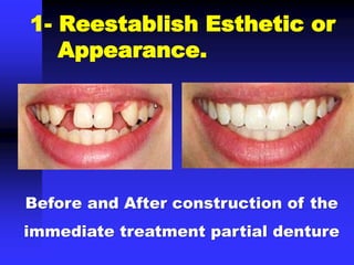 1- Reestablish Esthetic or
Appearance.
Before and After construction of the
immediate treatment partial denture
 