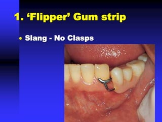1. ‘Flipper’ Gum strip
 Slang - No Clasps
 