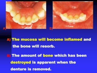 A) The mucosa will become inflamed and
the bone will resorb.
B) The amount of bone which has been
destroyed is apparent when the
denture is removed.
A) B)
 