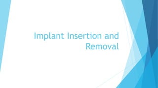 Implant Insertion and
Removal
 