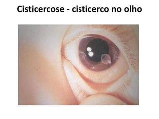 Cisticercose - cisticerco no olho
 