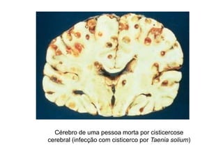 Cérebro de uma pessoa morta por cisticercose
cerebral (infecção com cisticerco por Taenia solium)
 