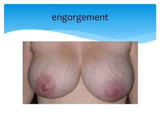 engorgement
 