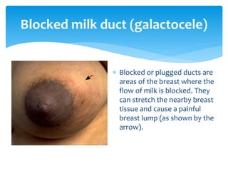  Blocked or plugged ducts are
areas of the breast where the
flow of milk is blocked. They
can stretch the nearby breast
tissue and cause a painful
breast lump (as shown by the
arrow).
Blocked milk duct (galactocele)
 