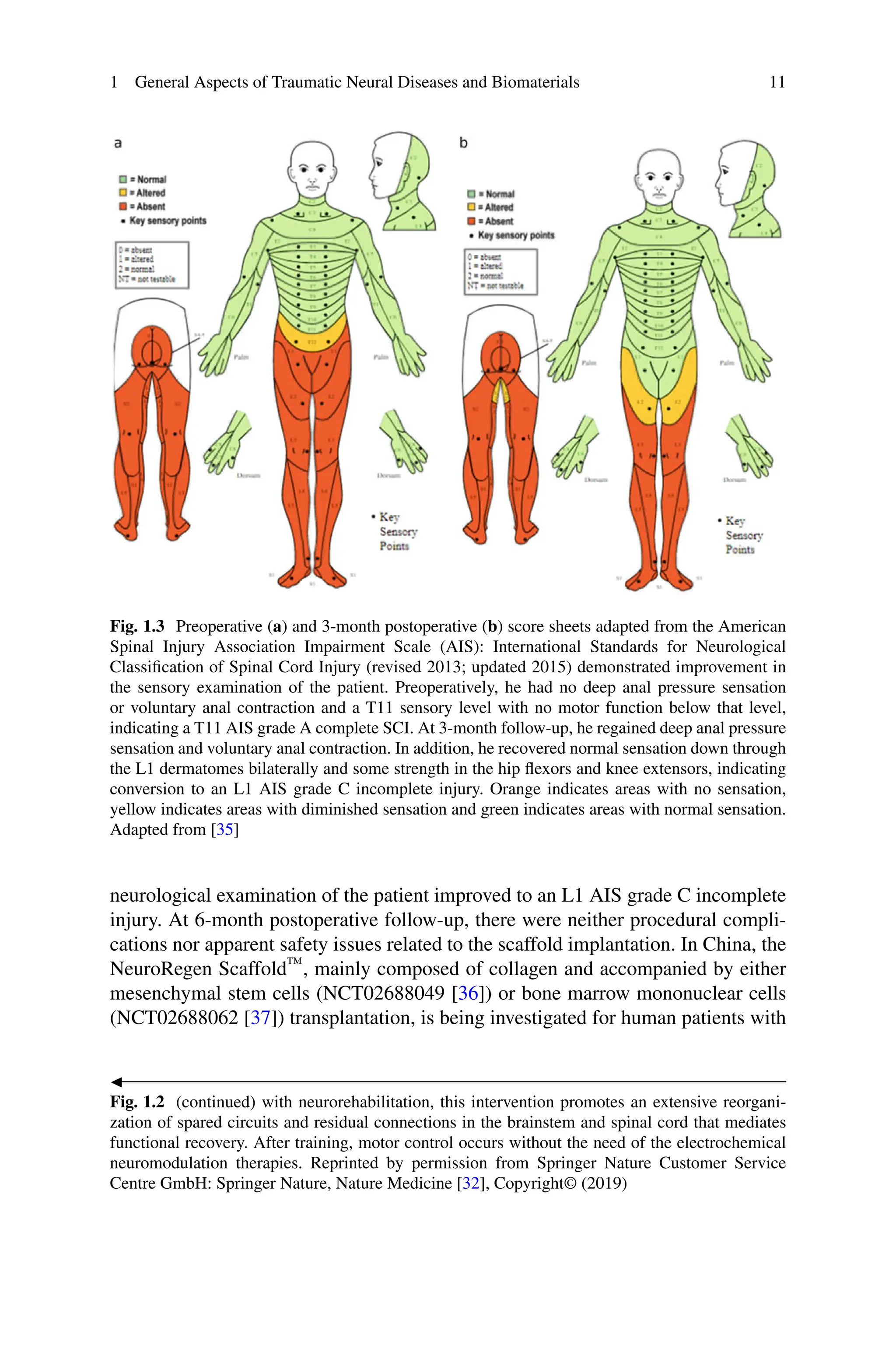 1 General Aspects of Traumatic Neural Diseases and Biomaterials 11
Fig. 1.3 Preoperative (a) and 3-month postoperative (b) score sheets adapted from the American
Spinal Injury Association Impairment Scale (AIS): International Standards for Neurological
Classification of Spinal Cord Injury (revised 2013; updated 2015) demonstrated improvement in
the sensory examination of the patient. Preoperatively, he had no deep anal pressure sensation
or voluntary anal contraction and a T11 sensory level with no motor function below that level,
indicating a T11 AIS grade A complete SCI. At 3-month follow-up, he regained deep anal pressure
sensation and voluntary anal contraction. In addition, he recovered normal sensation down through
the L1 dermatomes bilaterally and some strength in the hip flexors and knee extensors, indicating
conversion to an L1 AIS grade C incomplete injury. Orange indicates areas with no sensation,
yellow indicates areas with diminished sensation and green indicates areas with normal sensation.
Adapted from [35]
neurological examination of the patient improved to an L1 AIS grade C incomplete
injury. At 6-month postoperative follow-up, there were neither procedural compli-
cations nor apparent safety issues related to the scaffold implantation. In China, the
NeuroRegen Scaffold™, mainly composed of collagen and accompanied by either
mesenchymal stem cells (NCT02688049 [36]) or bone marrow mononuclear cells
(NCT02688062 [37]) transplantation, is being investigated for human patients with

Fig. 1.2 (continued) with neurorehabilitation, this intervention promotes an extensive reorgani-
zation of spared circuits and residual connections in the brainstem and spinal cord that mediates
functional recovery. After training, motor control occurs without the need of the electrochemical
neuromodulation therapies. Reprinted by permission from Springer Nature Customer Service
Centre GmbH: Springer Nature, Nature Medicine [32], Copyright© (2019)
 