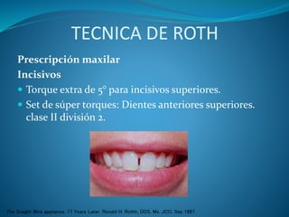 TECNICA DE ROTH
Prescripción maxilar
Incisivos
 Torque extra de 5° para incisivos superiores.
 Set de súper torques: Dientes anteriores superiores.
clase II división 2.
The Sraight Wire appliance, 17 Years Later. Ronald H. Rothh, DDS, Ms. JCO, Sep 1987.
 