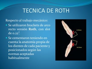 TECNICA DE ROTH
Respecto al trabajo mecánico:
 Se utilizaron brackets de arco
recto versión Roth, con slot
de 0.22”.
 Se cementaron teniendo en
cuenta la anatomía propia de
los dientes de cada paciente y
posicionados según las
normas aceptadas
habitualmente
 