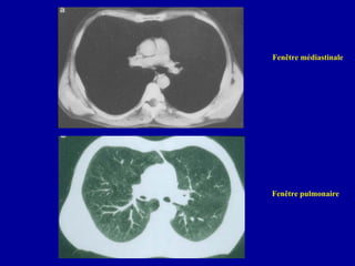 Fenêtre médiastinale
Fenêtre pulmonaire
 