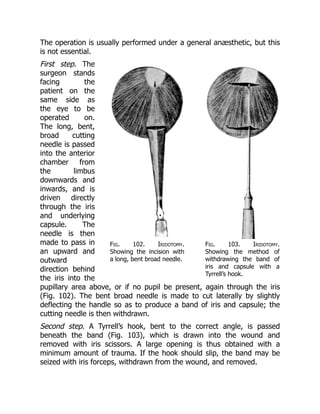 Fig. 102. Iridotomy.
Showing the incision with
a long, bent broad needle.
Fig. 103. Iridotomy.
Showing the method of
withdrawing the band of
iris and capsule with a
Tyrrell’s hook.
The operation is usually performed under a general anæsthetic, but this
is not essential.
First step. The
surgeon stands
facing the
patient on the
same side as
the eye to be
operated on.
The long, bent,
broad cutting
needle is passed
into the anterior
chamber from
the limbus
downwards and
inwards, and is
driven directly
through the iris
and underlying
capsule. The
needle is then
made to pass in
an upward and
outward
direction behind
the iris into the
pupillary area above, or if no pupil be present, again through the iris
(Fig. 102). The bent broad needle is made to cut laterally by slightly
deflecting the handle so as to produce a band of iris and capsule; the
cutting needle is then withdrawn.
Second step. A Tyrrell’s hook, bent to the correct angle, is passed
beneath the band (Fig. 103), which is drawn into the wound and
removed with iris scissors. A large opening is thus obtained with a
minimum amount of trauma. If the hook should slip, the band may be
seized with iris forceps, withdrawn from the wound, and removed.
 