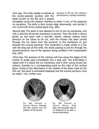 puncture in the iris; the cutting is
performed by a sawing movement.
First step. The knife needle is entered at
the corneo-sclerotic junction with the
blade turned on the flat and is passed
completely across the anterior chamber to within 3 mm. of the apparent
iris periphery. The knife is then turned edge downwards, and carried 3
mm. to the left of the vertical plane (Fig. 104).
Second step. The point is now allowed to rest on the iris membrane, and
with a dart-like thrust the membrane is pierced. Then the knife is drawn
gently up and down with a saw-like motion, without making much
pressure on the tissue to be cut, until the incision has been carried
through the iris tissue from the puncture in the membrane to just
beneath the corneal puncture. This movement is made wholly in a line
with the long axis of the knife, the shank passing to and fro through the
corneal puncture, loss of the aqueous being avoided in the manipulation
(Fig. 105).
Third step. The pressure of the vitreous will now cause the edges of the
incision to bulge open immediately into a long oval. The knife-blade is
raised until it is above the iris membrane, and is then swung across the
anterior chamber to a corresponding point on the right of the vertical
plane. Owing to the disturbance in the relation of the parts made by the
first cut, this point is somewhat displaced and the second puncture must
be made 1 mm. further over.
Fig. 105. Iridotomy by
Ziegler’s Method. Showing
the first incision and the
position of the second.
Fig. 106. Iridotomy by
Ziegler’s Method. Final
step; the triangular flap of
iris attached at its base is
turned downwards.
 