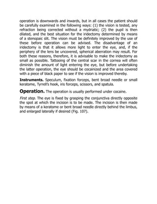 operation is downwards and inwards, but in all cases the patient should
be carefully examined in the following ways: (1) the vision is tested, any
refraction being corrected without a mydriatic; (2) the pupil is then
dilated, and the best situation for the iridectomy determined by means
of a stenopaic slit. The vision must be definitely improved by the use of
these before operation can be advised. The disadvantage of an
iridectomy is that it allows more light to enter the eye, and, if the
periphery of the lens be uncovered, spherical aberration may result. For
both these reasons, therefore, it is advisable to make the iridectomy as
small as possible. Tattooing of the central scar in the cornea will often
diminish the amount of light entering the eye, but before undertaking
the latter operation, the eye should be cocainized and the area covered
with a piece of black paper to see if the vision is improved thereby.
Instruments. Speculum, fixation forceps, bent broad needle or small
keratome, Tyrrell’s hook, iris forceps, scissors, and spatula.
Operation. The operation is usually performed under cocaine.
First step. The eye is fixed by grasping the conjunctiva directly opposite
the spot at which the incision is to be made. The incision is then made
by means of a keratome or bent broad needle directly behind the limbus,
and enlarged laterally if desired (Fig. 107).
 