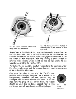 Fig. 109.
Optical
Iridectomy.
Fig. 107. Optical Iridectomy. The incision
being made with a keratome.
Fig. 108. Optical Iridectomy. Method of
removing the iris to produce a small
coloboma.
Second step. A Tyrrell’s hook, bent at the correct angle, is passed on the
flat into the anterior chamber. When the margin of the iris is reached the
handle is rotated and the hook is made to engage the free border of the
iris, which is then withdrawn from the wound; a small portion is
removed with scissors, which should be held at right angles to the
wound when dividing the iris (Fig. 108).
Third step. The iris should be carefully replaced and the pupil kept under
the influence of eserine until the anterior chamber has re-formed, when
atropine should be substituted.
Care must be taken to see that the Tyrrell’s hook
presents no sharp angle, and great care is required in its
manipulation, otherwise the lens capsule may be
damaged, and traumatic cataract will result. If the iris
slips from the grasp of the Tyrrell’s hook, iris forceps
should be used, the iris being grasped near its free
margin and as small a portion as possible withdrawn.
 