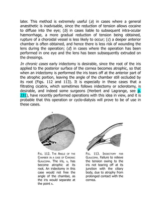later. This method is extremely useful (a) in cases where a general
anæsthetic is inadvisable, since the reduction of tension allows cocaine
to diffuse into the eye; (b) in cases liable to subsequent intra-ocular
hæmorrhage, a more gradual reduction of tension being obtained,
rupture of a choroidal vessel is less likely to occur; (c) a deeper anterior
chamber is often obtained, and hence there is less risk of wounding the
lens during the operation; (d) in cases where the operation has been
performed in one eye and the lens has been subsequently extruded on
the dressings.
In chronic cases early iridectomy is desirable, since the root of the iris
applied to the posterior surface of the cornea becomes atrophic, so that
when an iridectomy is performed the iris tears off at the anterior part of
the atrophic portion, leaving the angle of the chamber still occluded by
its root (Figs. 112 and 113). It is especially in these cases that a
filtrating cicatrix, which sometimes follows iridectomy or sclerotomy, is
desirable, and indeed some surgeons (Herbert and Lagrange, see p.
231), have recently performed operations with this idea in view, and it is
probable that this operation or cyclo-dialysis will prove to be of use in
these cases.
Fig. 112. The Angle of the
Chamber in a case of Chronic
Glaucoma. The iris, a, has
become atrophic at its
root. An iridectomy in this
case would not free the
angle of the chamber, as
the iris would separate at
the point a.
Fig. 113. Iridectomy for
Glaucoma. Failure to relieve
the tension owing to the
iris not tearing off at its
junction with the ciliary
body, due to atrophy from
prolonged contact with the
cornea.
 