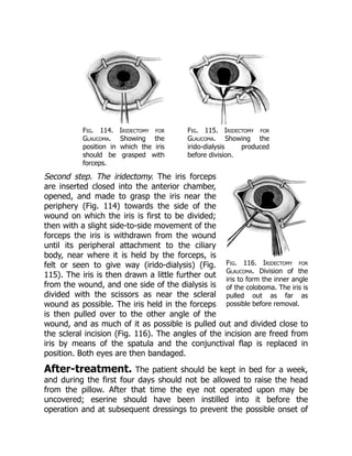 Fig. 116. Iridectomy for
Glaucoma. Division of the
iris to form the inner angle
of the coloboma. The iris is
pulled out as far as
possible before removal.
Fig. 114. Iridectomy for
Glaucoma. Showing the
position in which the iris
should be grasped with
forceps.
Fig. 115. Iridectomy for
Glaucoma. Showing the
irido-dialysis produced
before division.
Second step. The iridectomy. The iris forceps
are inserted closed into the anterior chamber,
opened, and made to grasp the iris near the
periphery (Fig. 114) towards the side of the
wound on which the iris is first to be divided;
then with a slight side-to-side movement of the
forceps the iris is withdrawn from the wound
until its peripheral attachment to the ciliary
body, near where it is held by the forceps, is
felt or seen to give way (irido-dialysis) (Fig.
115). The iris is then drawn a little further out
from the wound, and one side of the dialysis is
divided with the scissors as near the scleral
wound as possible. The iris held in the forceps
is then pulled over to the other angle of the
wound, and as much of it as possible is pulled out and divided close to
the scleral incision (Fig. 116). The angles of the incision are freed from
iris by means of the spatula and the conjunctival flap is replaced in
position. Both eyes are then bandaged.
After-treatment. The patient should be kept in bed for a week,
and during the first four days should not be allowed to raise the head
from the pillow. After that time the eye not operated upon may be
uncovered; eserine should have been instilled into it before the
operation and at subsequent dressings to prevent the possible onset of
 