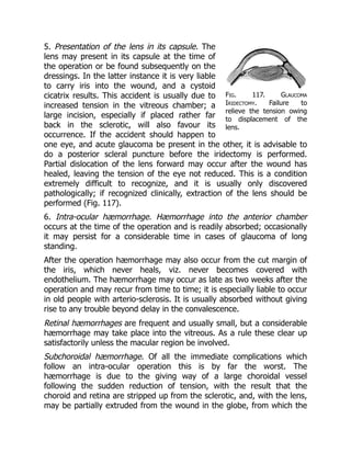 Fig. 117. Glaucoma
Iridectomy. Failure to
relieve the tension owing
to displacement of the
lens.
5. Presentation of the lens in its capsule. The
lens may present in its capsule at the time of
the operation or be found subsequently on the
dressings. In the latter instance it is very liable
to carry iris into the wound, and a cystoid
cicatrix results. This accident is usually due to
increased tension in the vitreous chamber; a
large incision, especially if placed rather far
back in the sclerotic, will also favour its
occurrence. If the accident should happen to
one eye, and acute glaucoma be present in the other, it is advisable to
do a posterior scleral puncture before the iridectomy is performed.
Partial dislocation of the lens forward may occur after the wound has
healed, leaving the tension of the eye not reduced. This is a condition
extremely difficult to recognize, and it is usually only discovered
pathologically; if recognized clinically, extraction of the lens should be
performed (Fig. 117).
6. Intra-ocular hæmorrhage. Hæmorrhage into the anterior chamber
occurs at the time of the operation and is readily absorbed; occasionally
it may persist for a considerable time in cases of glaucoma of long
standing.
After the operation hæmorrhage may also occur from the cut margin of
the iris, which never heals, viz. never becomes covered with
endothelium. The hæmorrhage may occur as late as two weeks after the
operation and may recur from time to time; it is especially liable to occur
in old people with arterio-sclerosis. It is usually absorbed without giving
rise to any trouble beyond delay in the convalescence.
Retinal hæmorrhages are frequent and usually small, but a considerable
hæmorrhage may take place into the vitreous. As a rule these clear up
satisfactorily unless the macular region be involved.
Subchoroidal hæmorrhage. Of all the immediate complications which
follow an intra-ocular operation this is by far the worst. The
hæmorrhage is due to the giving way of a large choroidal vessel
following the sudden reduction of tension, with the result that the
choroid and retina are stripped up from the sclerotic, and, with the lens,
may be partially extruded from the wound in the globe, from which the
 