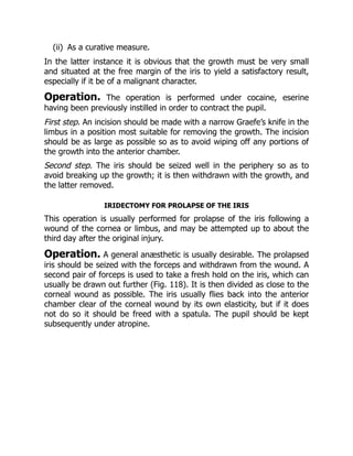 (ii) As a curative measure.
In the latter instance it is obvious that the growth must be very small
and situated at the free margin of the iris to yield a satisfactory result,
especially if it be of a malignant character.
Operation. The operation is performed under cocaine, eserine
having been previously instilled in order to contract the pupil.
First step. An incision should be made with a narrow Graefe’s knife in the
limbus in a position most suitable for removing the growth. The incision
should be as large as possible so as to avoid wiping off any portions of
the growth into the anterior chamber.
Second step. The iris should be seized well in the periphery so as to
avoid breaking up the growth; it is then withdrawn with the growth, and
the latter removed.
IRIDECTOMY FOR PROLAPSE OF THE IRIS
This operation is usually performed for prolapse of the iris following a
wound of the cornea or limbus, and may be attempted up to about the
third day after the original injury.
Operation. A general anæsthetic is usually desirable. The prolapsed
iris should be seized with the forceps and withdrawn from the wound. A
second pair of forceps is used to take a fresh hold on the iris, which can
usually be drawn out further (Fig. 118). It is then divided as close to the
corneal wound as possible. The iris usually flies back into the anterior
chamber clear of the corneal wound by its own elasticity, but if it does
not do so it should be freed with a spatula. The pupil should be kept
subsequently under atropine.
 
