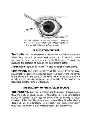 Fig. 118. Prolapse of the Iris through a Punctured
Wound of the Cornea. Method of withdrawing the iris
by two pairs of iris forceps before removal.
TRANSFIXION OF THE IRIS
Indications. This operation is undertaken in cases of iris bombé
when iritis is still present and when an iridectomy would
subsequently lead to a drawn-up pupil. It is also of service to
evacuate the contents of cysts of the iris (local iris bombé).
Instruments. Speculum, fixation forceps, Graefe’s knife (narrow).
Operation. The knife is entered at the limbus from the outer
side directly opposite the occluded pupil. The apex of the iris bombé
is transfixed and the point of the knife made to appear above the
pupillary area; the iris bombé on the other side of the pupil is then
transfixed and the knife is withdrawn.
THE DIVISION OF ANTERIOR SYNECHIÆ
Indications. Anterior synechiæ rarely require division unless
they are likely to cause tension or the adherent iris is considered a
source of danger to the eye on account of its liability to septic
infection. If the synechiæ are causing tension, the method of division
described under sclerotomy is probably the most satisfactory;
otherwise the following method devised by Lang can be used.
 