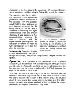 Fig. 119. Cyclo-dialysis Operation.
Showing the method of commencing
the incision in the sclerotic; it is
subsequently deepened with the point
of the knife. The dotted lines mark the
incision for turning forward the
conjunctival flap.
dislocation of the lens backwards, associated with increased tension,
where iridectomy would certainly be followed by loss of the vitreous.
The operation has for its object
the separation of the ligamentum
pectinatum from its attachment to
the sclerotic, with the probable
result that the ciliary body and iris
root become retracted by the
ciliary muscle, so that the canal of
Schlemm is opened up and again
communicates with the anterior
chamber. It also opens up a free
communication between the
anterior chamber and the
suprachoroidal lymph-spaces. The
reduction of tension is often not
fully manifest for about ten days
after the operation.
Instruments. Speculum, fixation
forceps, Graefe’s knife, fine pair of
straight iris forceps, fine pair of sharp-pointed straight scissors, iris
spatula.
Operation. The operation is best performed under a general
anæsthetic, as it is attended with considerable pain, although cocaine
and adrenalin are frequently used and are always advisable, since the
hæmorrhage from the scleral vessels renders it difficult to gauge the
depth of the wound in the sclerotic.
First step. By means of the straight iris forceps and sharp-pointed
scissors a semilunar conjunctival flap is first raised over the site for
the scleral incision. The incision in the sclerotic should be situated
about 5 mm. behind the corneo-sclerotic junction over the ciliary
region, the outer and upper quadrant of the eye being the easiest
position for subsequent manipulation (Fig. 119).
 