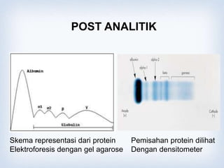 Skema representasi dari protein
Elektroforesis dengan gel agarose
Pemisahan protein dilihat
Dengan densitometer
POST ANALITIK
 
