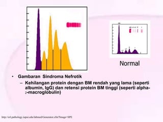• Gambaran Sindroma Nefrotik
– Kehilangan protein dengan BM rendah yang lama (seperti
albumin, IgG) dan retensi protein BM tinggi (seperti alpha-
2-macroglobulin)
http://erl.pathology.iupui.edu/labmed/Generator.cfm?Image=SPE
Normal
 