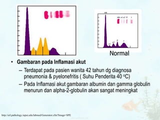 • Gambaran pada Inflamasi akut
– Terdapat pada pasien wanita 42 tahun dg diagnosa
pneumonia & pyelonefritis ( Suhu Penderita 40 oC)
– Pada Inflamasi akut gambaran albumin dan gamma globulin
menurun dan alpha-2-globulin akan sangat meningkat
Normal
http://erl.pathology.iupui.edu/labmed/Generator.cfm?Image=SPE
 